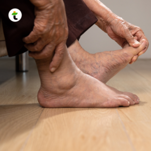Sendi Bengkak Gejala Asam Urat pada Kaki