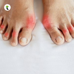 Nyeri Sendi Gejala Asam Urat pada Kaki