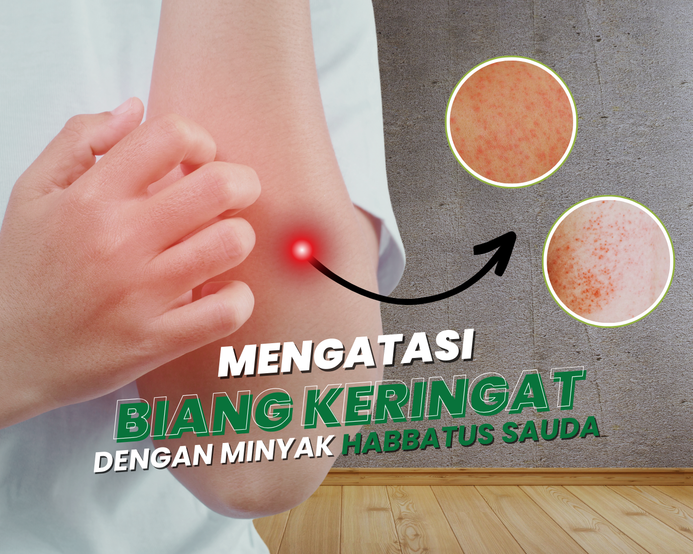 Gejala Biang Keringat pada Bayi Sembuh dengan Minyak Habbatus Sauda
