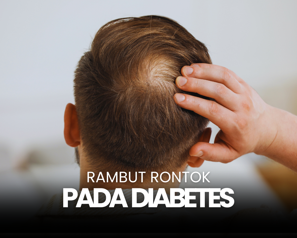 Kebotakan pada Penderita Diabetes, Apa Penyebabnya?