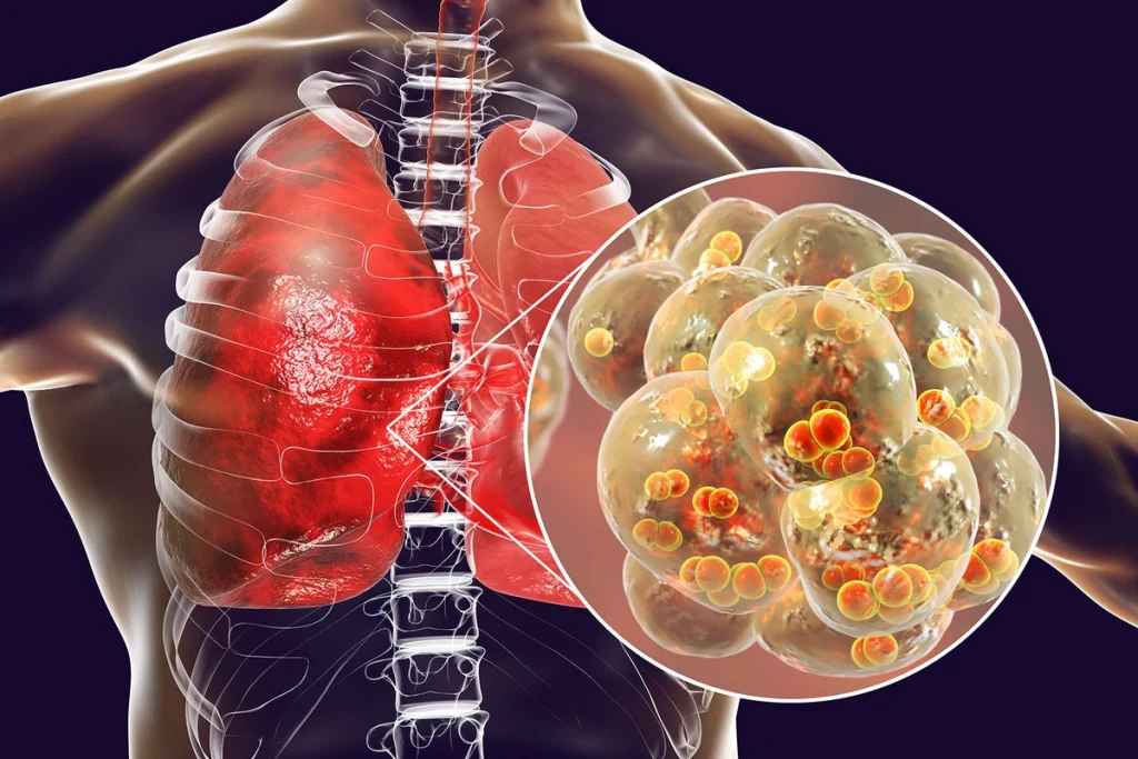 Pneumonia